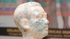 Emicrania e stress, l’agopuntura spiega la connessione
