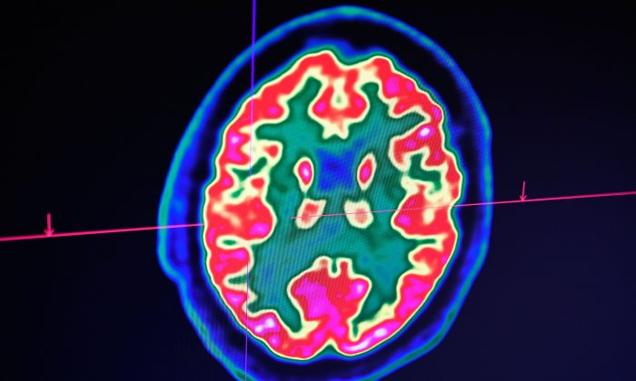Ricercatori affermano di aver scoperto la causa dell’Alzheimer