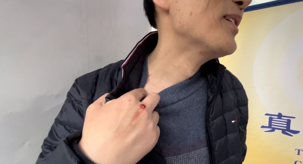 Praticante del Falun Gong David Fang mostra le ferite da un’aggressione nel quartiere Flushing del Queens, New York, 16 febbraio 2023. (Linda Lin/Epoch Times)