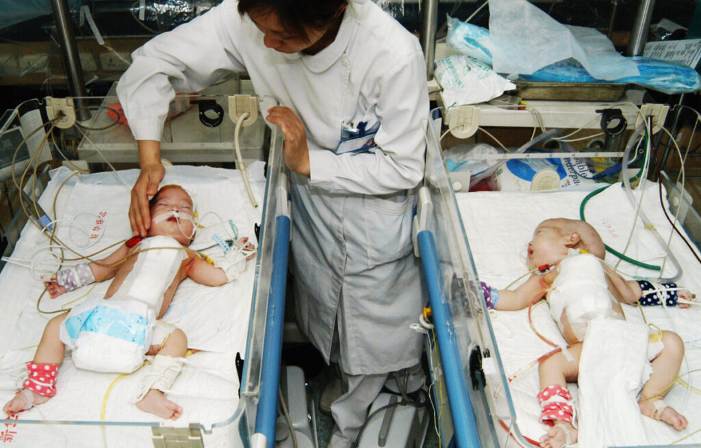 Un’infermiera controlla una coppia di gemelli siamesi di Shanxi Province dopo la loro separazione chirurgica, 1 giugno 2005, allo Xinhua Hospital in Shanghai, China. (China Photos/Getty Images)