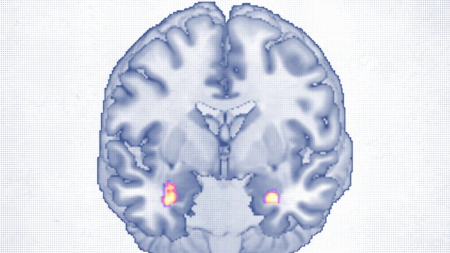 La terapia cognitivo-comportamentale rimodella la struttura cerebrale