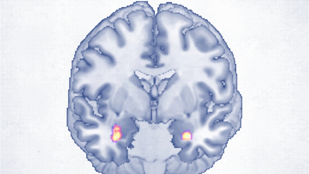 La terapia cognitivo-comportamentale rimodella la struttura cerebrale